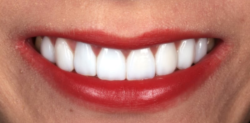 假牙不密合-變色-變黑-全瓷冠-陶瓷貼片-DSD微笑設計-療程後微笑曲線-朗日牙醫-台中