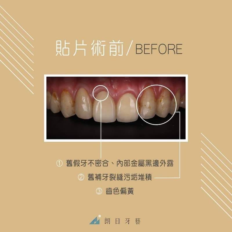 假牙不密合-變色-變黑-全瓷冠-陶瓷貼片-DSD微笑設計-療程前-朗日牙醫-台中