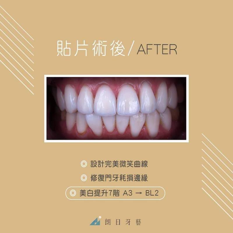 陶瓷貼片-推薦-台中-朗日牙藝-dsd數位微笑設計-牙齒微整型-Doris在陶瓷貼片療程後改善微笑曲線-並美白牙齒七階