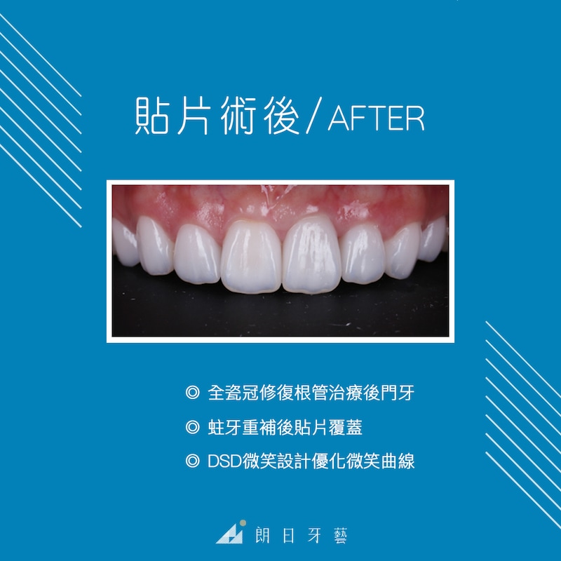 陶瓷貼片-推薦-台中牙醫診所-朗日牙藝-DSD數位微笑設計-全瓷冠-台北ＭS朱-全瓷冠修復根管治療的門牙-瓷牙貼片修復蛀牙