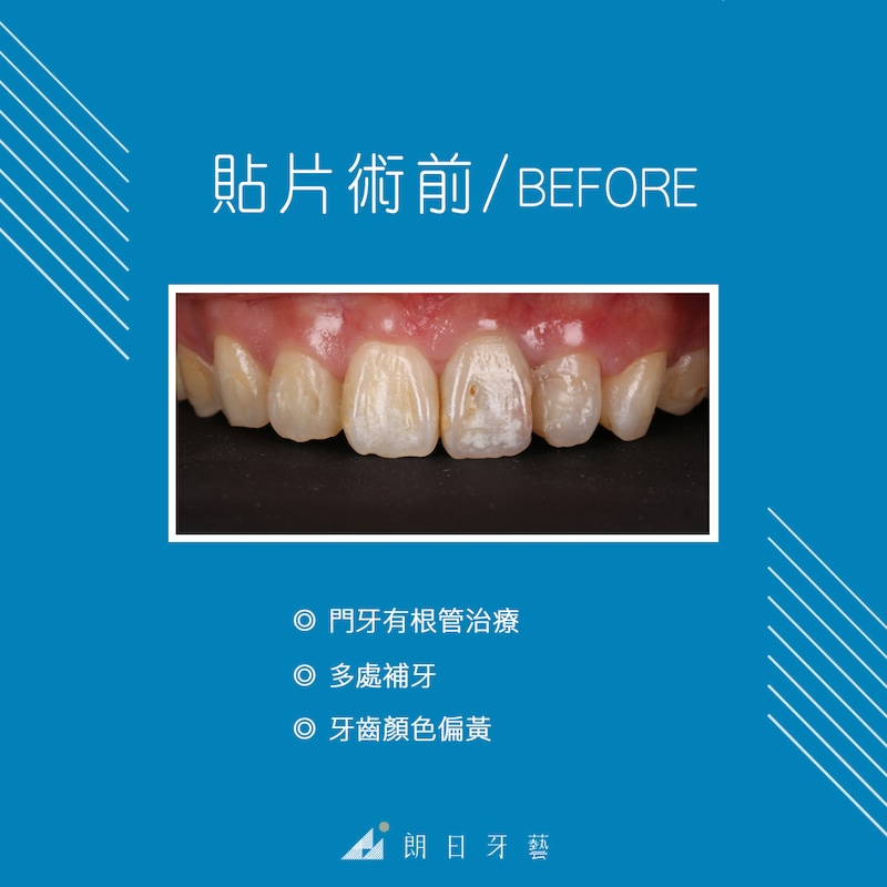 陶瓷貼片-推薦-台中牙醫診所-朗日牙藝-DSD數位微笑設計-全瓷冠-台北ＭS朱-療程前門牙根管治療後變色-牙齒黃-補牙