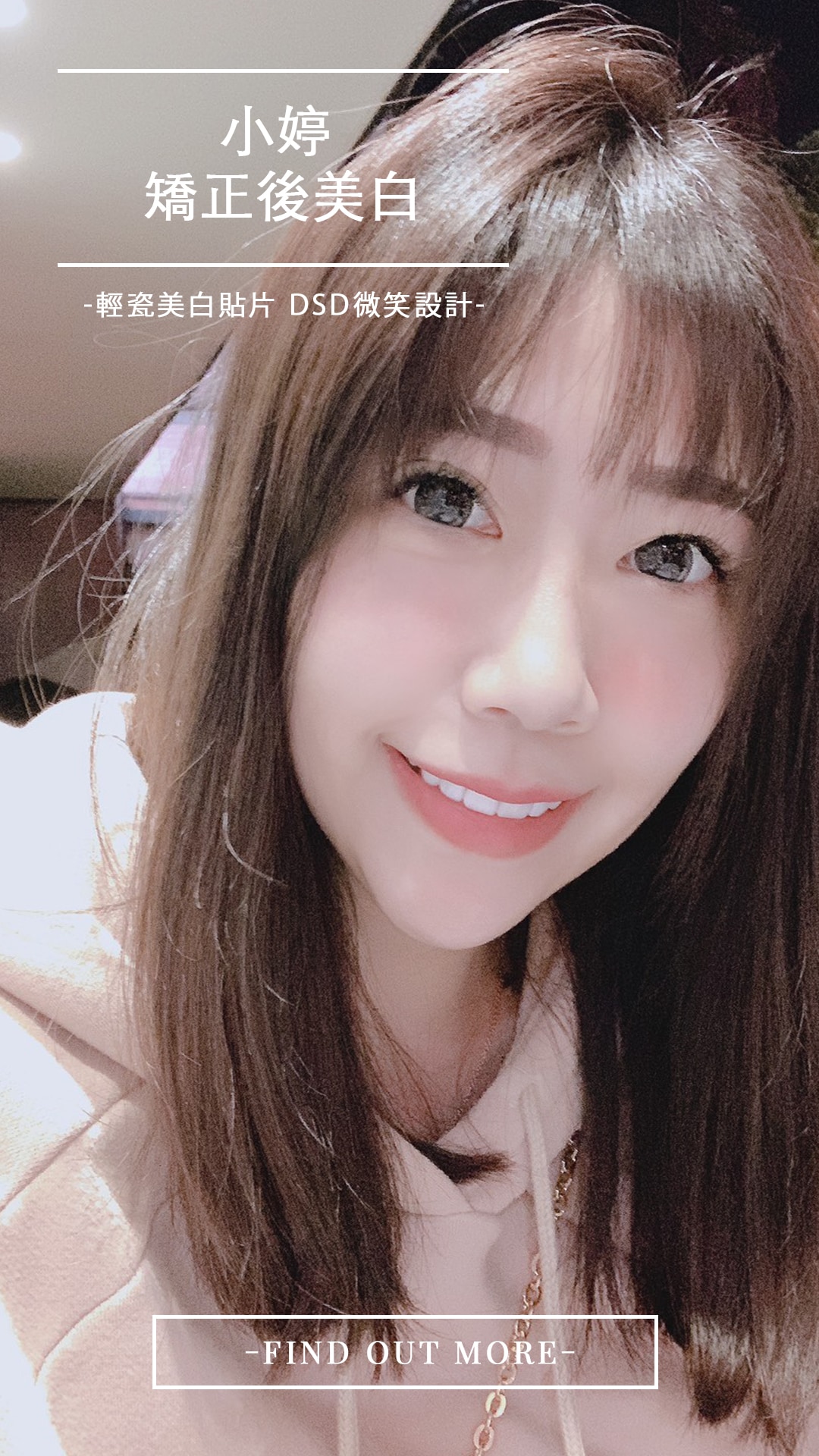 Read more about the article 戴牙套難清潔導致牙黃怎麼辦？陶瓷貼片讓她大方開心自拍！