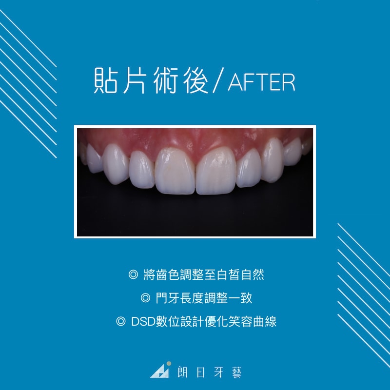 牙齒美白-DSD數位微笑設計-一日美齒-推薦-台中-朗日牙藝