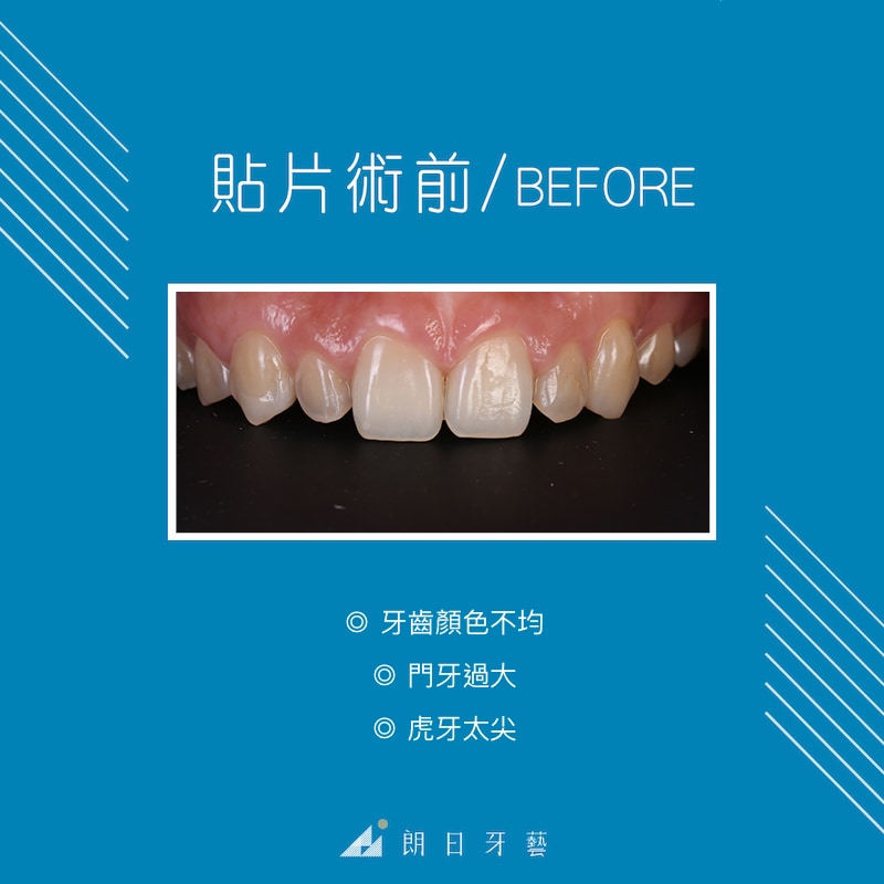 牙齒顏色不均-牙齒形狀不好看-虎牙尖-牙齒微矯正-台中陶瓷貼片-推薦-朗日牙藝