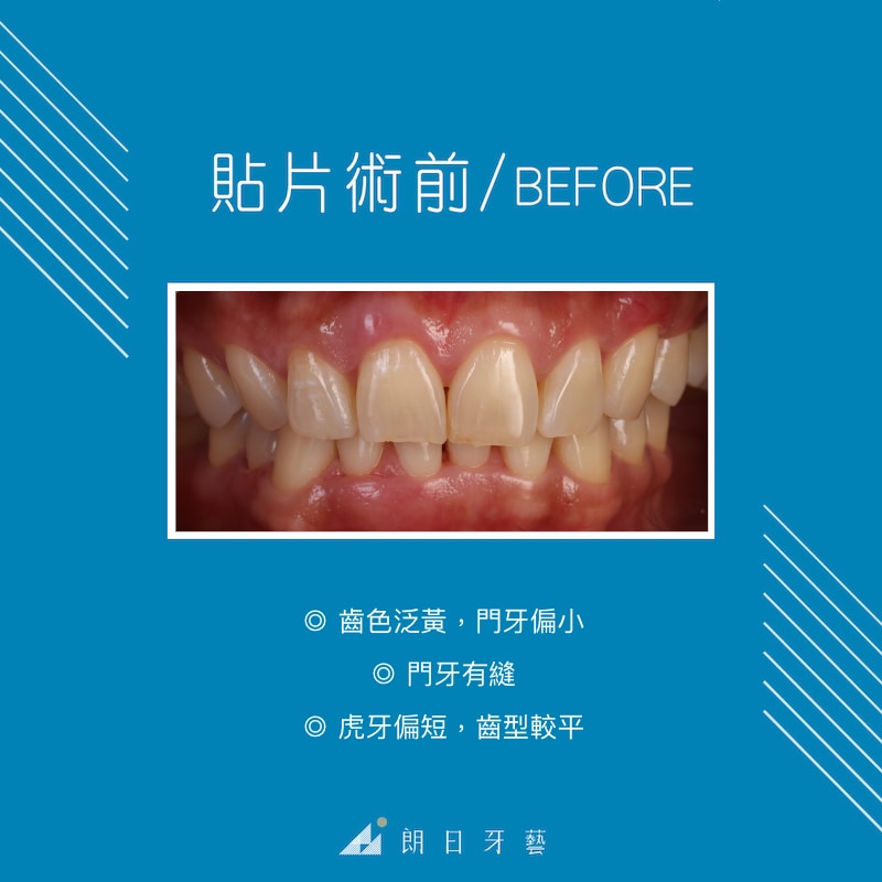 牙齒黃-門牙有縫-門牙偏小-虎牙短-台中陶瓷貼片-推薦-朗日牙藝