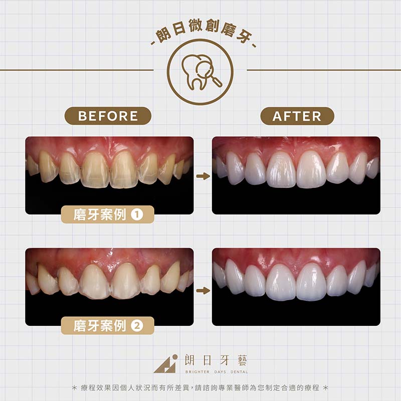 陶瓷貼片壽命-關鍵-微創磨牙-陶瓷貼片-案例-顯微微創磨牙治療前後比較圖-台中-朗日牙醫