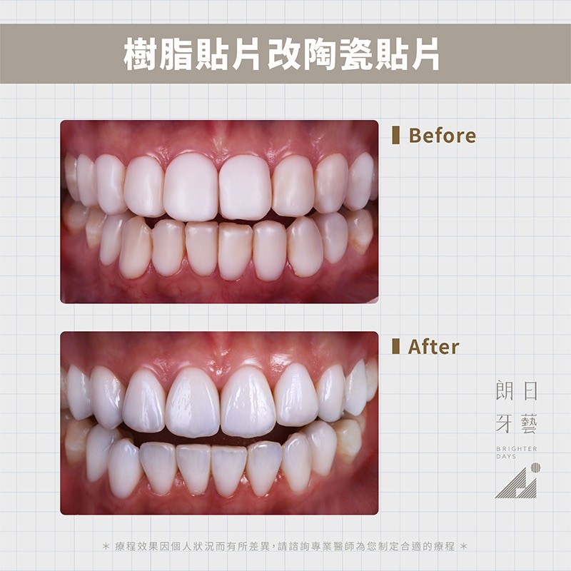 樹脂貼片-牙齒貼片失敗拆除-台中陶瓷貼片-推薦-朗日牙藝