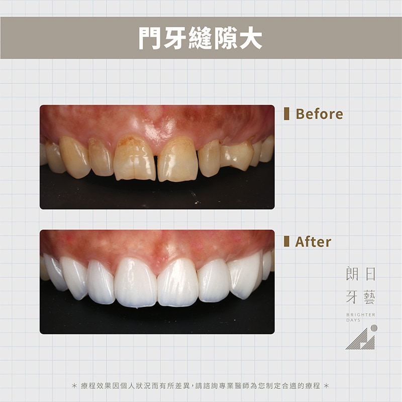 陶瓷貼片-修復門牙牙縫大-DSD微笑設計-台中一日美齒-朗日牙藝