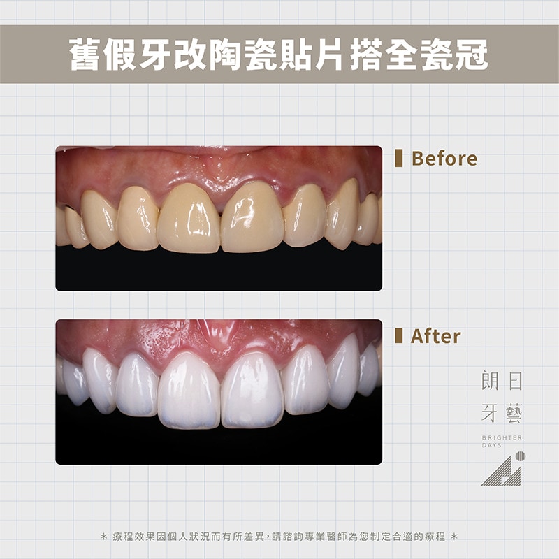 陶瓷貼片-全瓷冠-換假牙-台中牙齒美白推薦-朗日輕瓷美白貼片