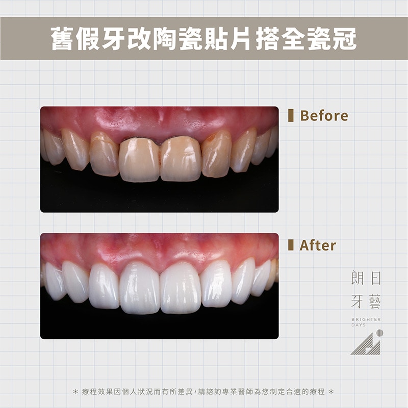 陶瓷貼片-全瓷冠-金屬假牙黑邊-DSD微笑設計-台中牙齒美白-朗日輕瓷美白貼片