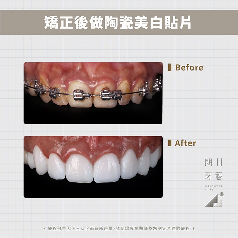 陶瓷貼片-戴牙套牙齒變黃-DSD微笑設計-台中陶瓷貼片推薦-朗日牙藝