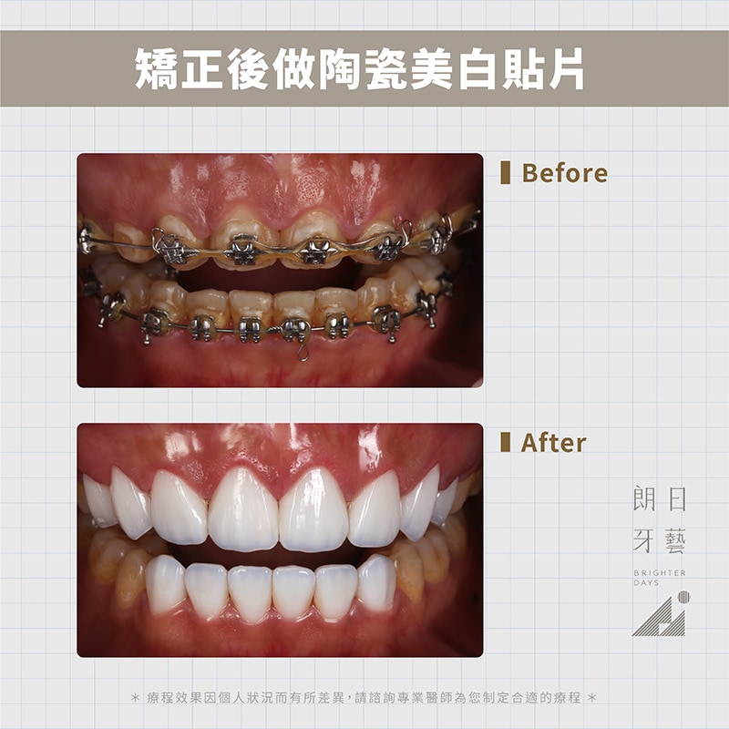 陶瓷貼片-戴牙套矯正後美白-DSD微笑設計-台中陶瓷貼片推薦-朗日牙藝