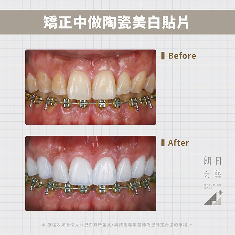 陶瓷貼片-拆牙套美白-DSD微笑設計-台中陶瓷貼片推薦-朗日牙藝