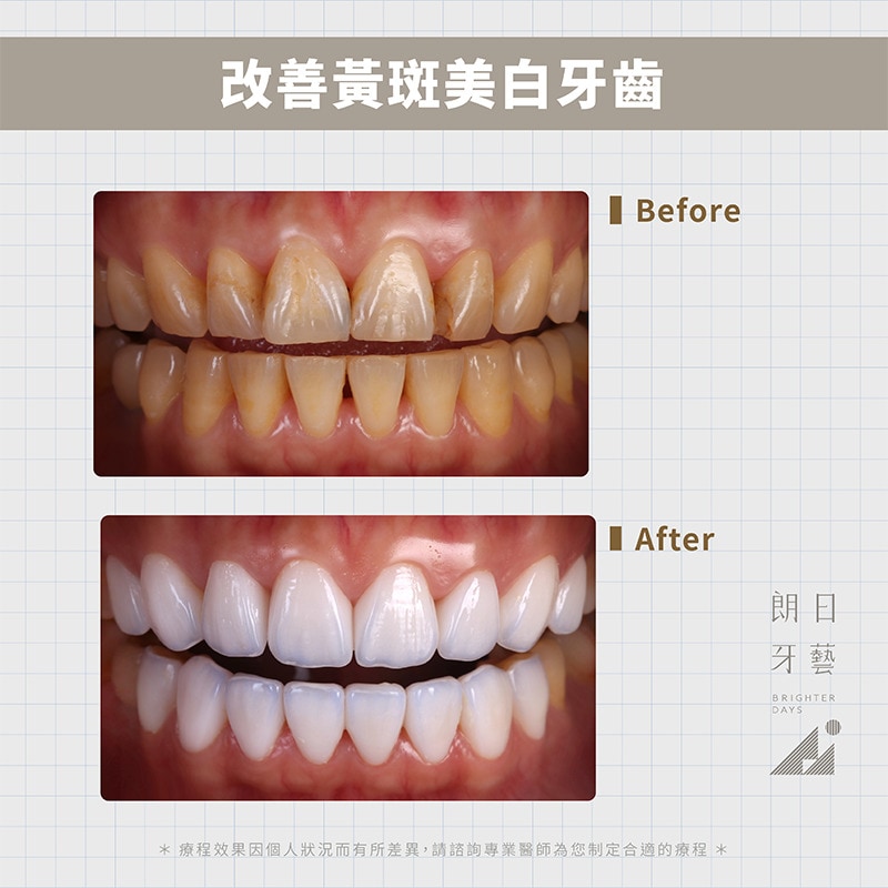 陶瓷貼片-牙齒黃-台中牙齒美白-推薦-朗日牙藝-輕瓷美白貼片