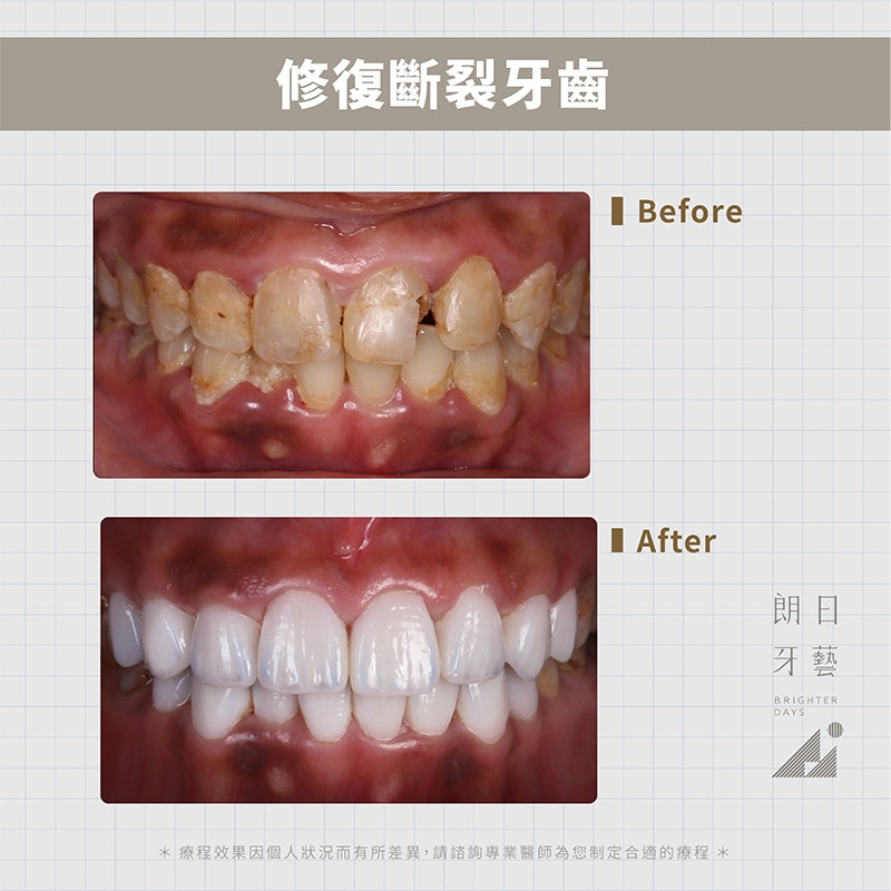 陶瓷貼片-門牙斷裂修補-牙齒美白-台中陶瓷貼片-朗日牙藝