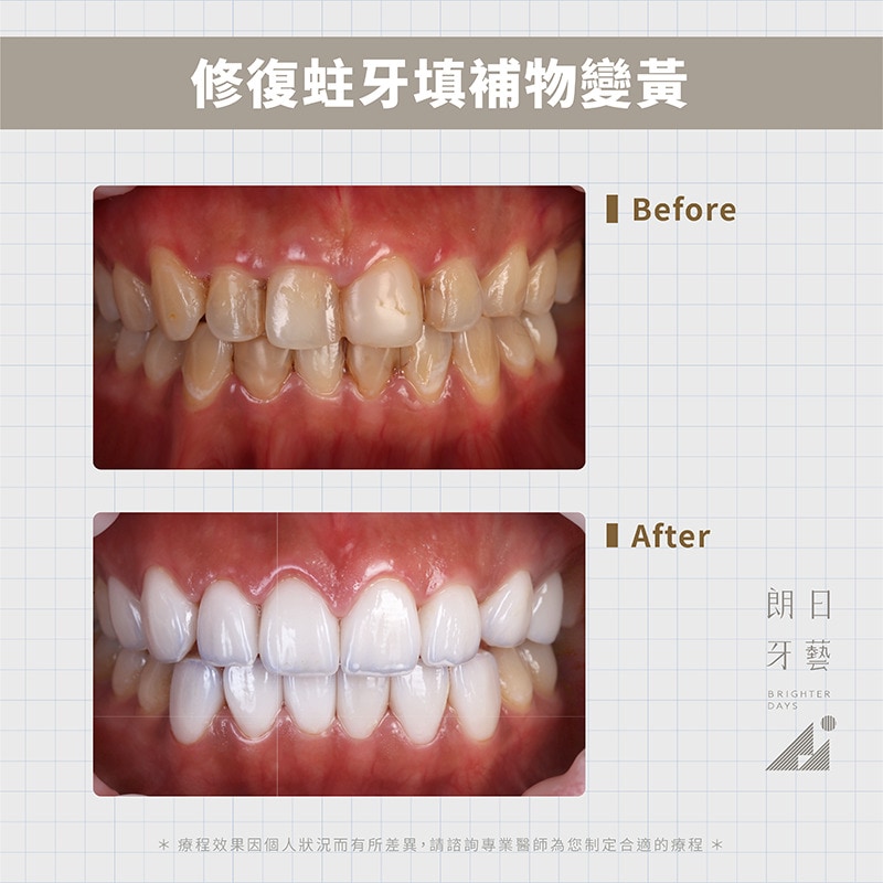 陶瓷貼片優點-修復補牙樹脂變色-台中牙齒美白-推薦-朗日牙藝