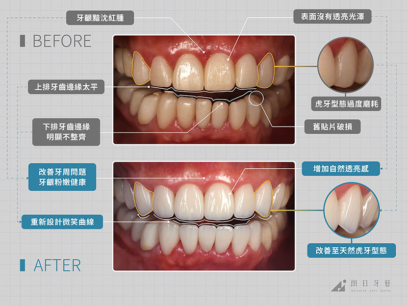 牙齒貼片失敗-陶瓷貼片後遺症-拆除重做案例-台中陶瓷貼片-朗日牙藝