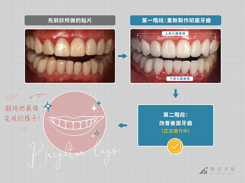 牙齒貼片失敗-陶瓷貼片後遺症-拆除重做療程前後對比-台中陶瓷貼片-朗日牙藝