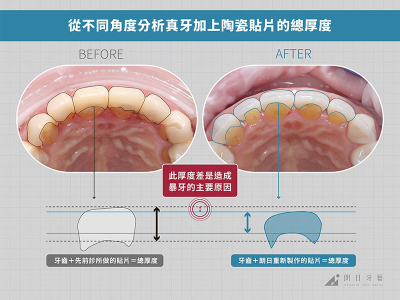 牙齒貼片失敗-陶瓷貼片後遺症-暴牙-拆除重做案例-台中陶瓷貼片-朗日牙藝
