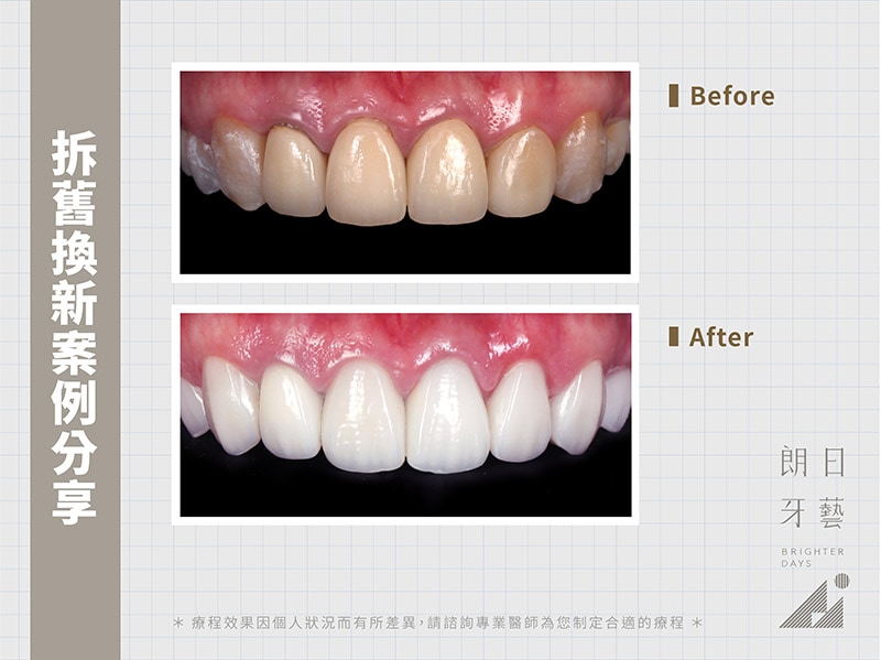 牙齒貼片失敗-陶瓷貼片後悔-拆舊換新案例分享-台中陶瓷貼片-朗日牙醫