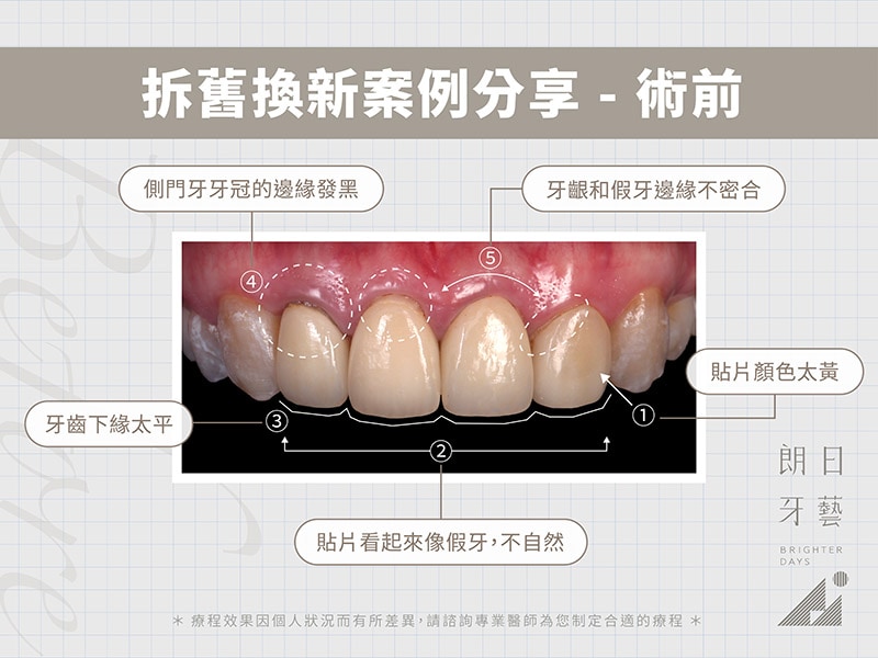 牙齒貼片失敗-陶瓷貼片後悔-拆舊換新療程前-台中陶瓷貼片-朗日牙醫