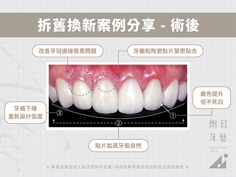 牙齒貼片失敗-陶瓷貼片後悔-拆舊換新療程後-台中陶瓷貼片-朗日牙醫