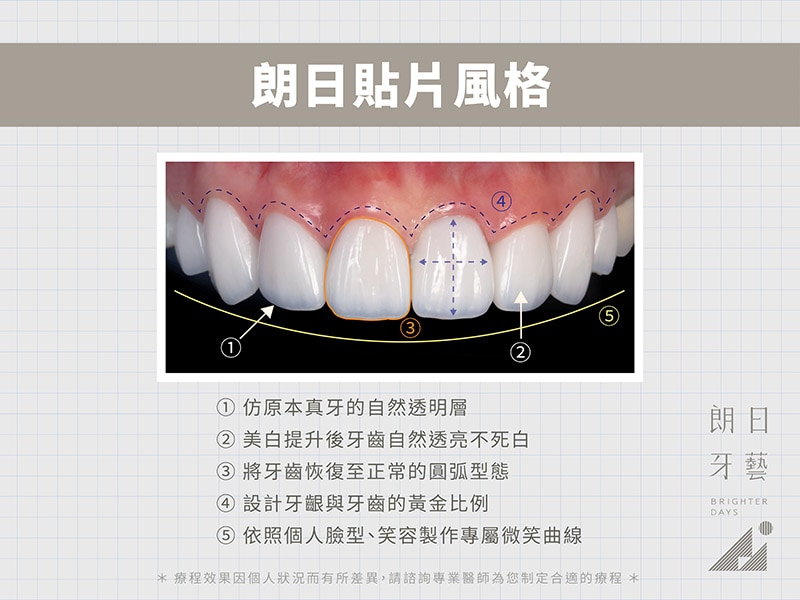 牙齒貼片失敗-陶瓷貼片後悔-朗日瓷牙貼片風格-台中陶瓷貼片-朗日牙醫