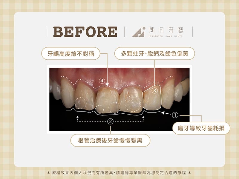 陶瓷貼片-牙齒不整齊-牙齒黃-磨牙牙齒磨損-療程前-朗日牙醫-台中