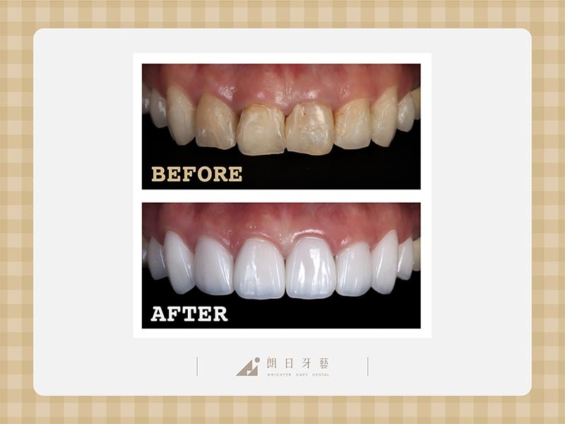 陶瓷貼片-牙齒不整齊-牙齒黃-磨牙牙齒磨損-療程前後比較-朗日牙醫-台中