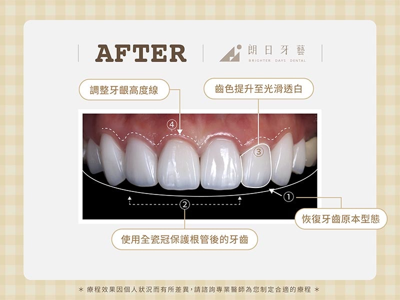 陶瓷貼片-牙齒不整齊-牙齒黃-磨牙牙齒磨損-療程後-朗日牙醫-台中