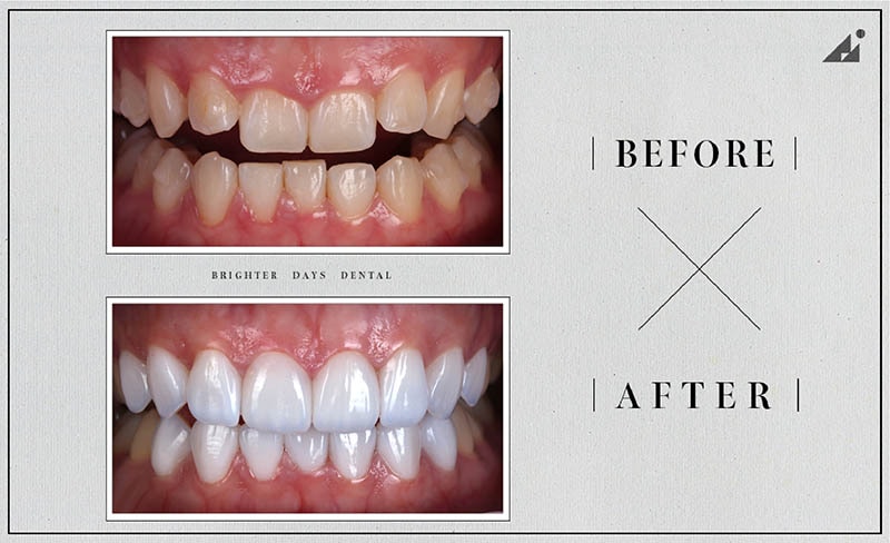 陶瓷貼片矯正-牙齒美白-療程前後對比-朗日牙醫-台中