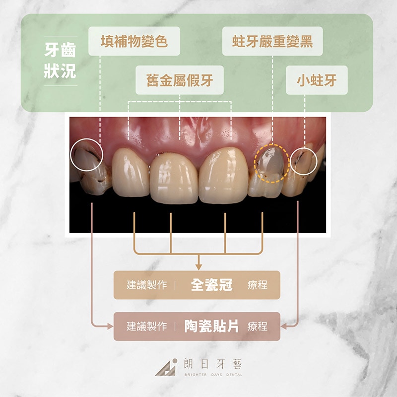 全瓷冠-陶瓷貼片-使用時機-推薦案例1-朗日牙藝-台中