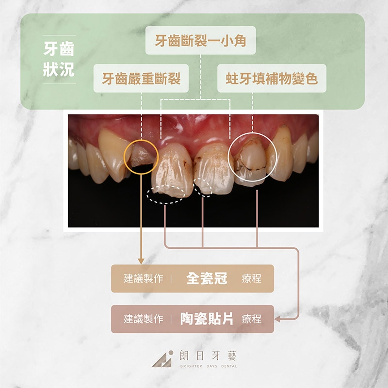 全瓷冠-陶瓷貼片-使用時機-推薦案例2-朗日牙藝-台中