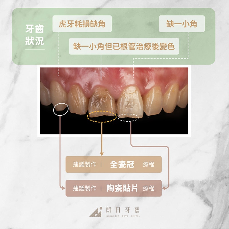 全瓷冠-陶瓷貼片-使用時機-推薦案例3-朗日牙藝-台中