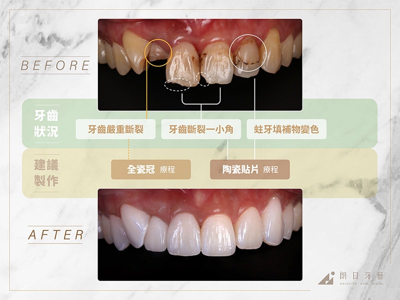 全瓷冠-陶瓷貼片-治療前後比較-推薦案例2-朗日牙藝-台中