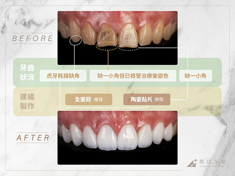 全瓷冠-陶瓷貼片-治療前後比較-推薦案例3-朗日牙藝-台中