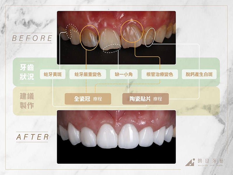 全瓷冠-陶瓷貼片-治療前後比較-推薦案例4-朗日牙藝-台中