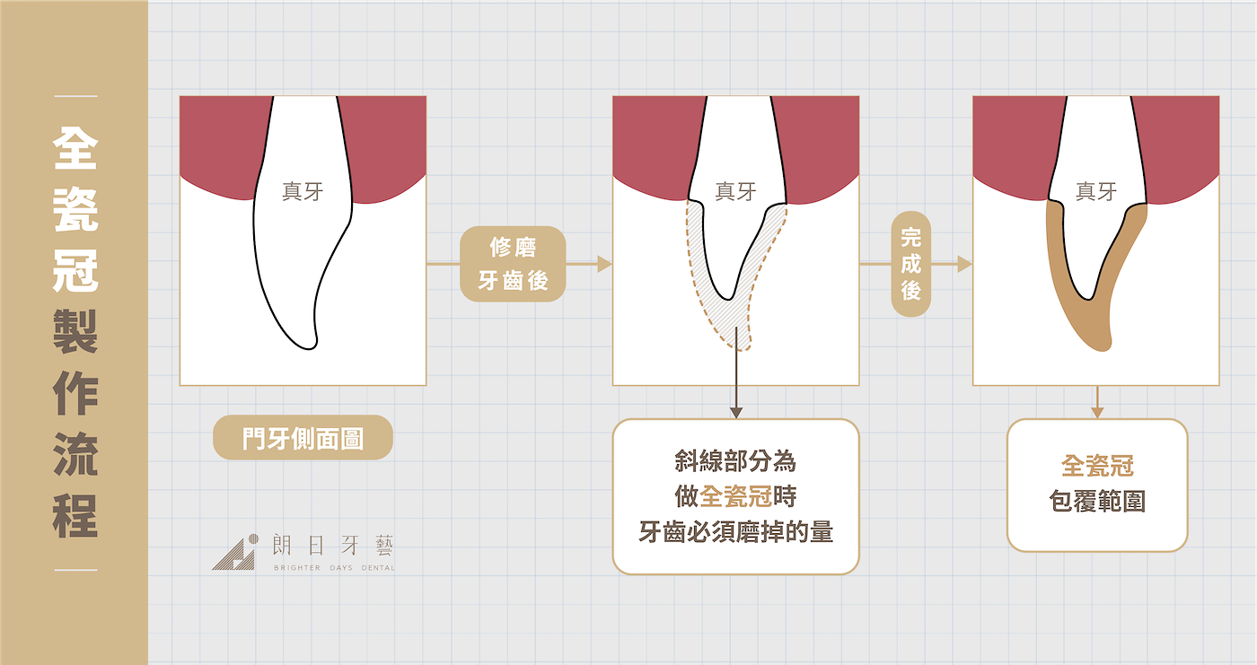 全瓷冠-陶瓷貼片-比較-全瓷冠製作流程-朗日牙藝-台中-pc-final-3