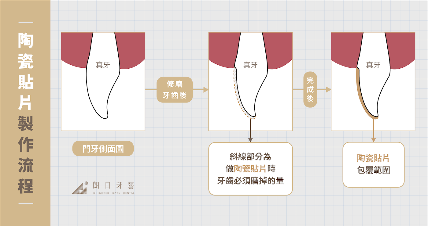 全瓷冠-陶瓷貼片-比較-陶瓷貼片製作流程-朗日牙藝-台中-pc-final-3