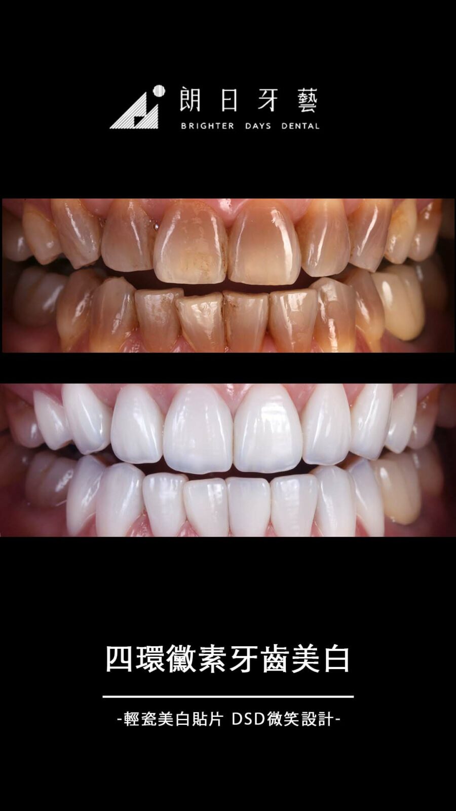 陶瓷貼片案例-四環黴素牙齒染色-四環黴素牙齒美白-朗日牙藝-輕瓷美白貼片