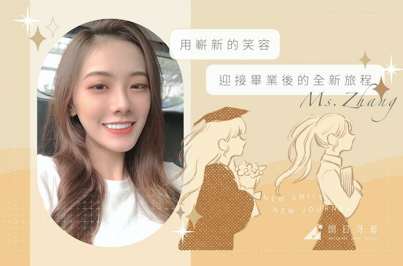 陶瓷貼片-磨牙-牙齒磨損-抽神經牙齒變黑-一日美齒-台中牙醫推薦-朗日牙醫