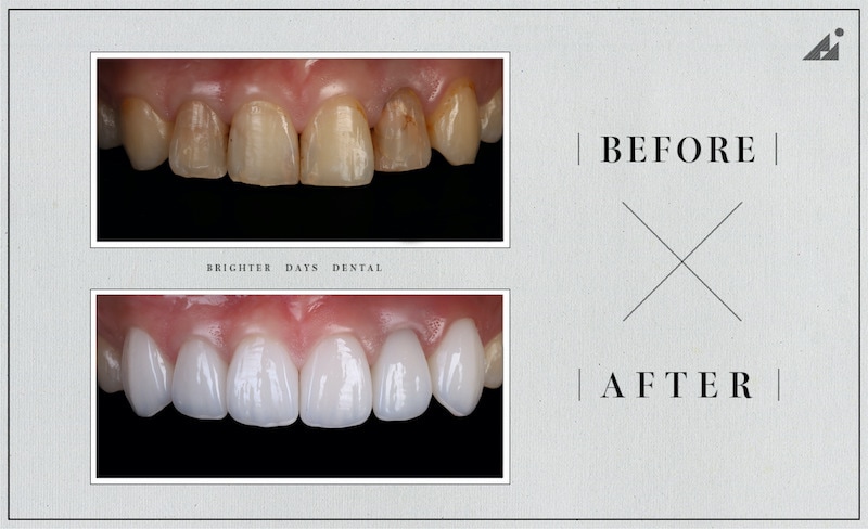 陶瓷貼片-磨牙-牙齒磨損-抽神經牙齒變黑-一日美齒-療程前後比較-朗日牙醫-台中