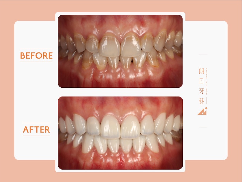 四環素牙治療前後比較，上下排各10顆陶瓷貼片一次美白牙齒並改善牙齒縫隙與排列