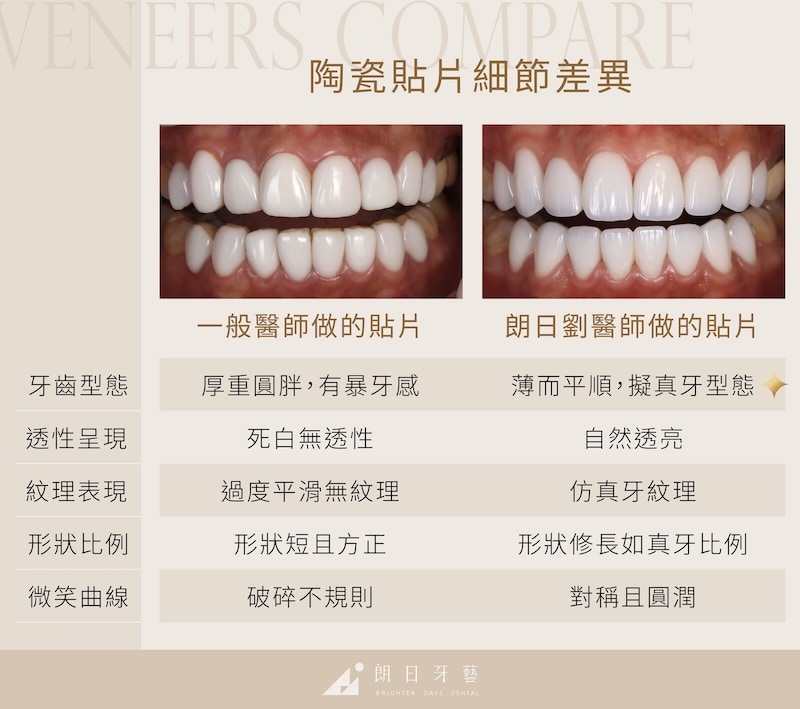 陶瓷貼片細節差異對照圖,左為一般醫師製作,右為朗日劉醫師貼片,清楚比較齒型比例、透亮度與微笑曲線
