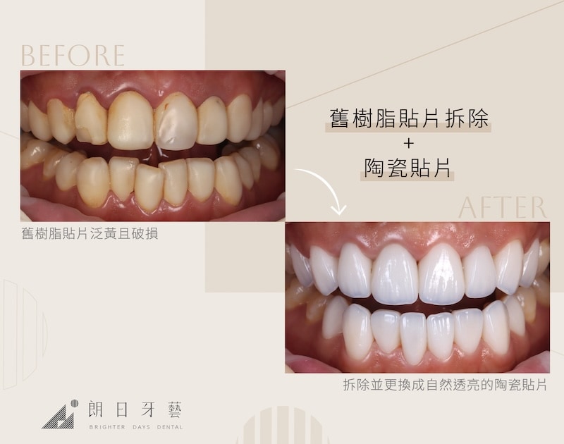 舊樹脂貼片泛黃破損,拆除後改以自然透亮的陶瓷貼片重做,改善色澤與質感