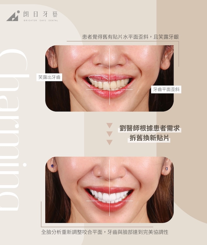 陶瓷貼片重做案例,修正舊貼片歪斜與微笑線不對稱問題,術後達到咬合平衡與笑容協調