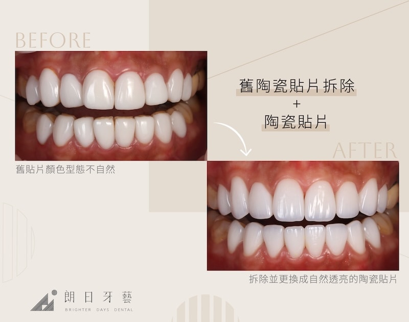 舊陶瓷貼片顏色型態不自然,拆除後重新製作陶瓷貼片,外觀呈現自然透亮質感