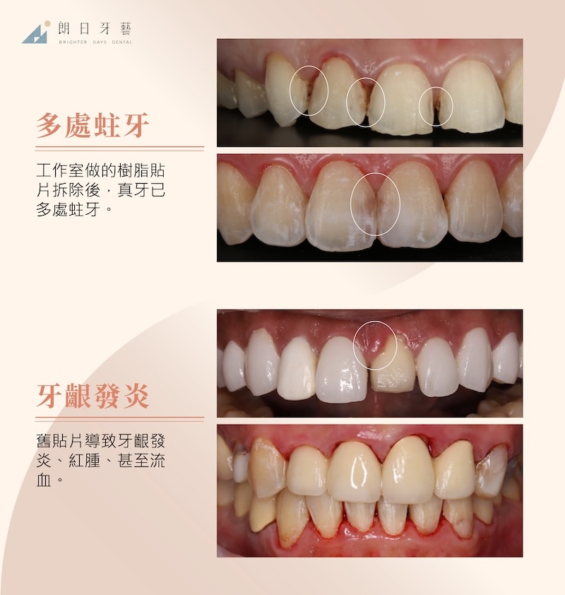 他院樹脂貼片拆除後可見多處蛀牙，舊貼片也導致牙齦紅腫、發炎甚至流血