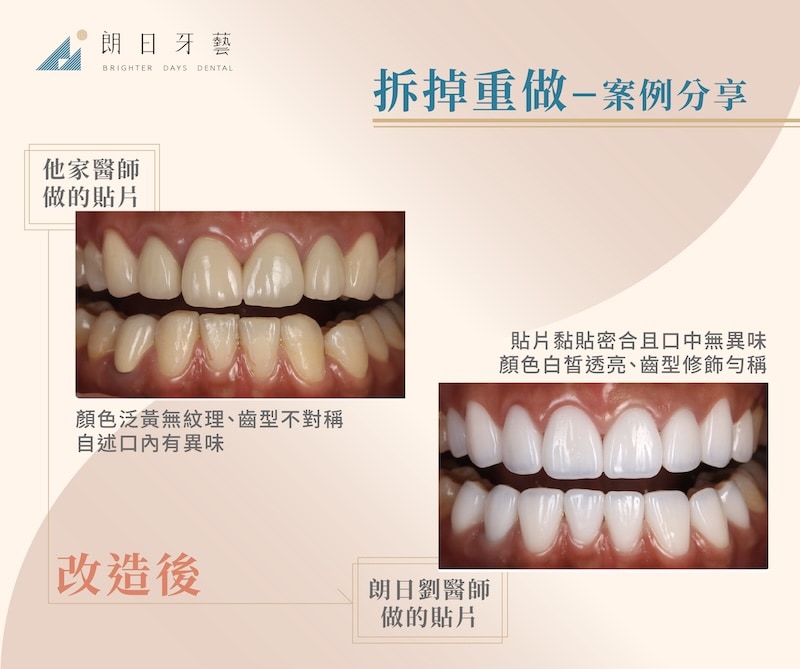 他院貼片顏色泛黃無紋理、齒型不對稱且口中有異味；朗日劉醫師拆除重做後，陶瓷貼片色澤透亮、齒型勻稱且口腔無異味