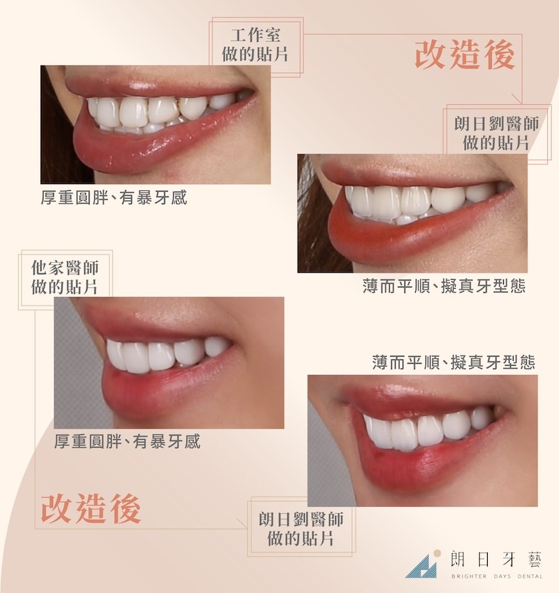 工作室／他院貼片厚重圓胖，造成暴牙感；朗日劉醫師改造後陶瓷貼片薄而平順，還原自然齒型